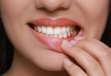 Sangramento na Gengiva: o que pode ser e quando é sinal de alerta 2025
