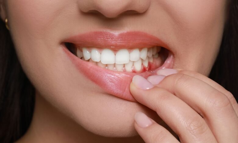 Sangramento na Gengiva: o que pode ser e quando é sinal de alerta 2025 1 Sangramento na Gengiva: o que pode ser e quando é sinal de alerta 2025