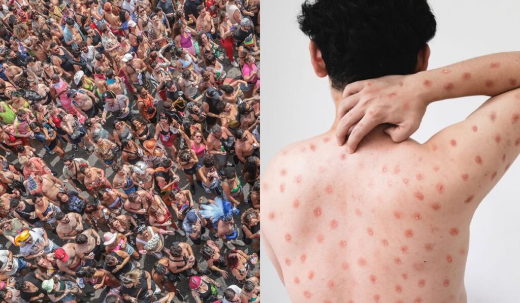 Mpox na Paraíba: autoridades reforçam alerta com casos no Carnaval 2 mpox na Paraíba