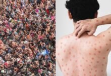 mpox na Para&iacute;ba