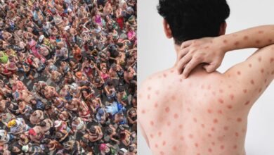 mpox na Para&iacute;ba