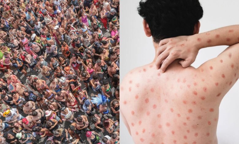 Mpox na Paraíba: autoridades reforçam alerta com casos no Carnaval 1 mpox na Paraíba